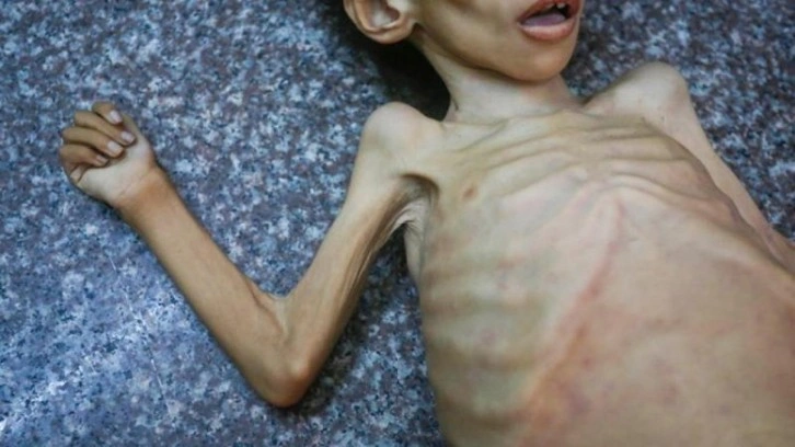 Katliam kahkahası! İsrail Gazze'de kıtlığı dayatıyor! 27 yaşında 15 kiloyken can verdi!