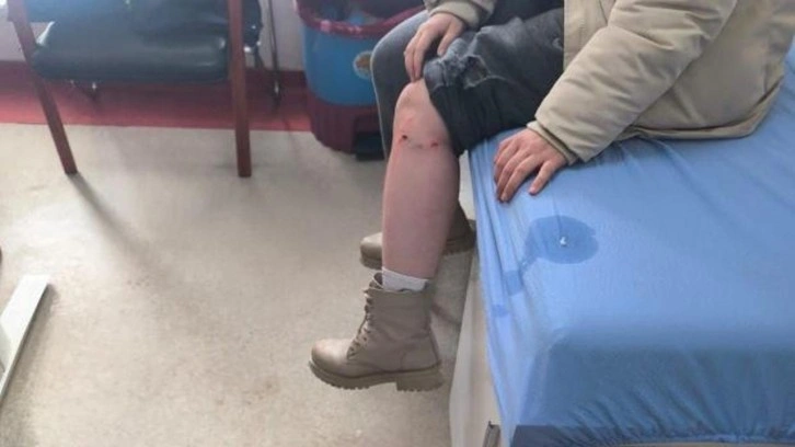 Kayseri&rsquo;de sokak k&ouml;peğinin saldırısına uğrayan &ccedil;ocuk yaralandı