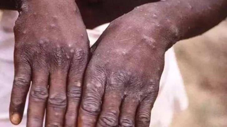 Sierra Leone’de maymun çiçeği alarmı...‘Acil durum’ ilan edildi!