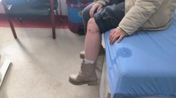 Kayseri&rsquo;de sokak k&ouml;peğinin saldırısına uğrayan &ccedil;ocuk yaralandı